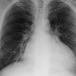 x-ray of Pulmonary Hypertension