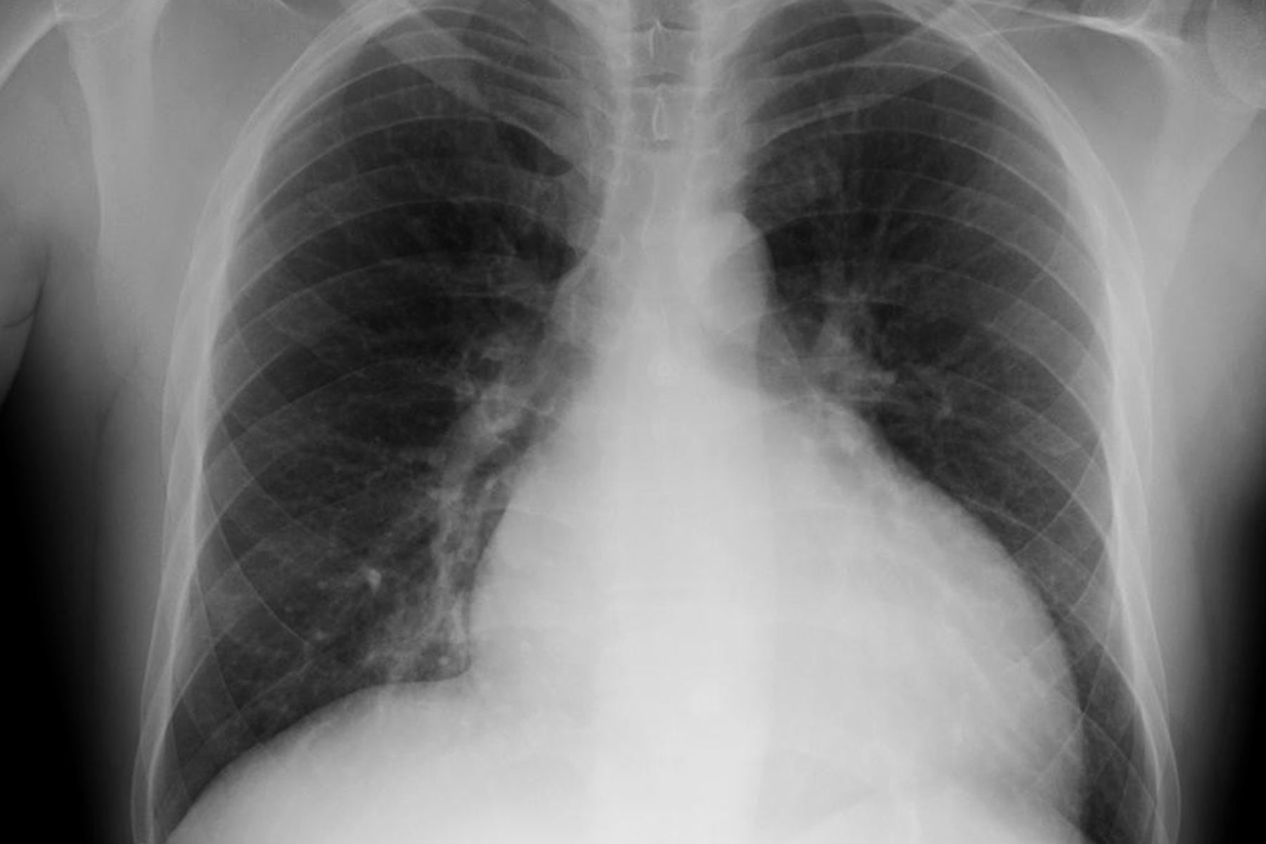 lung-cancer-patients-receive-more-radiation-than-recommended-uic-today