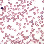 Blood smear illustrating sickle cell anemia