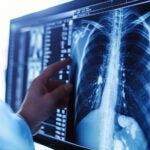 Lung cancer xray Doctor see lung x-rays result in hospital